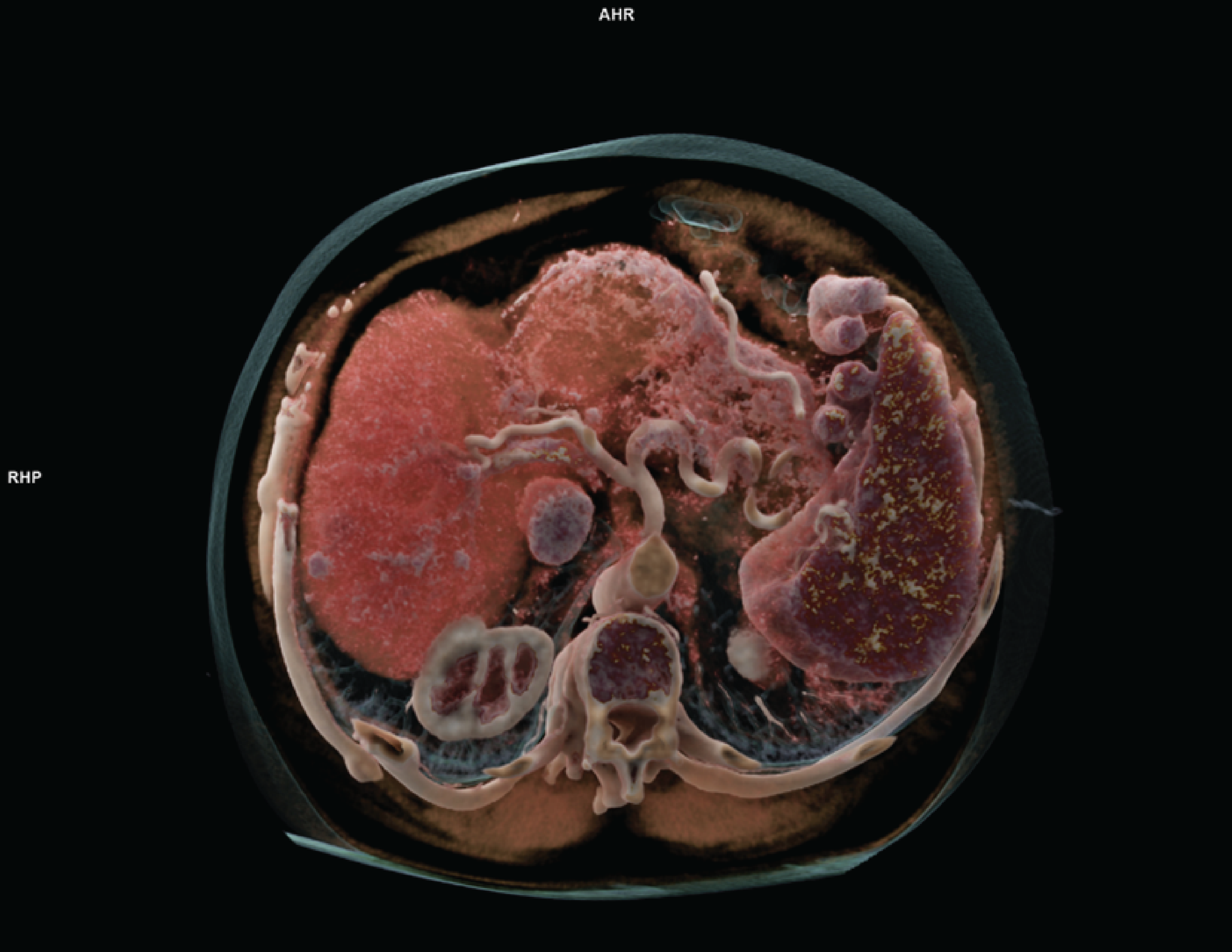 Alt text: A photo of a cross-sectional CT abdomen output image from the photon-counting CT NAEOTOM Alpha scanner by Siemens Healthineers.