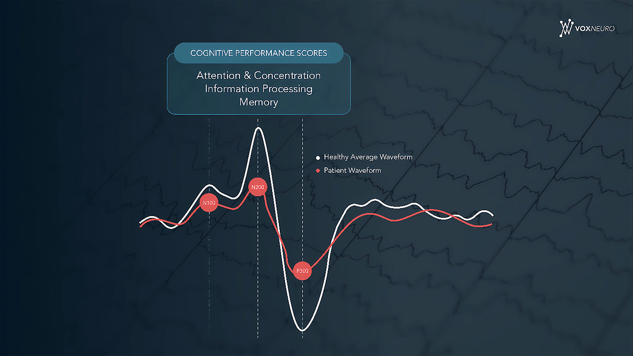 Note: The digital waveforms illustrate the amplitudes of event-related potential components (i.e., N100, N200, and P300). Decreased amplitude of a wave component can indicate impairment in attention and concentration, information processing, or memory.
