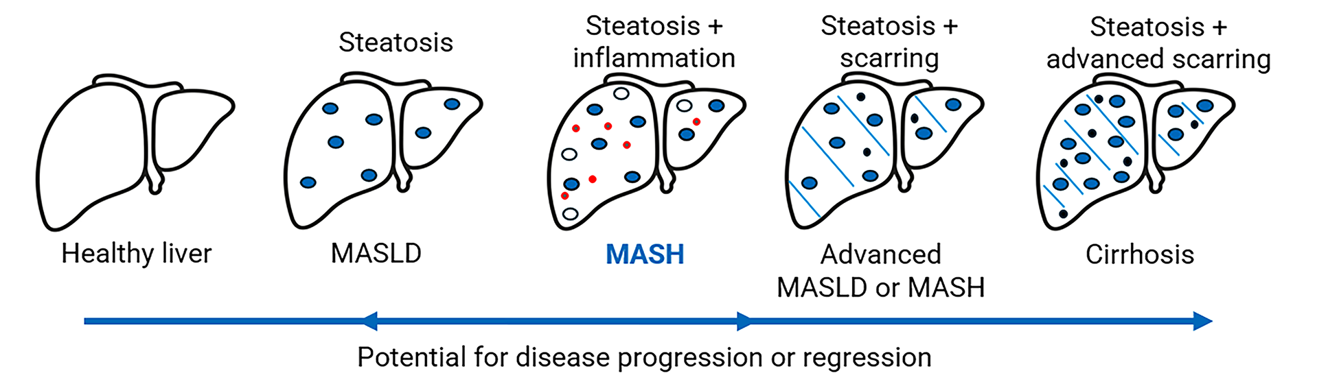 Diagram of progressive liver disease showing a healthy liver progressing to MASLD, then MASH, and finally cirrhosis. A bidirectional arrow indicates that stages can both progress and regress.