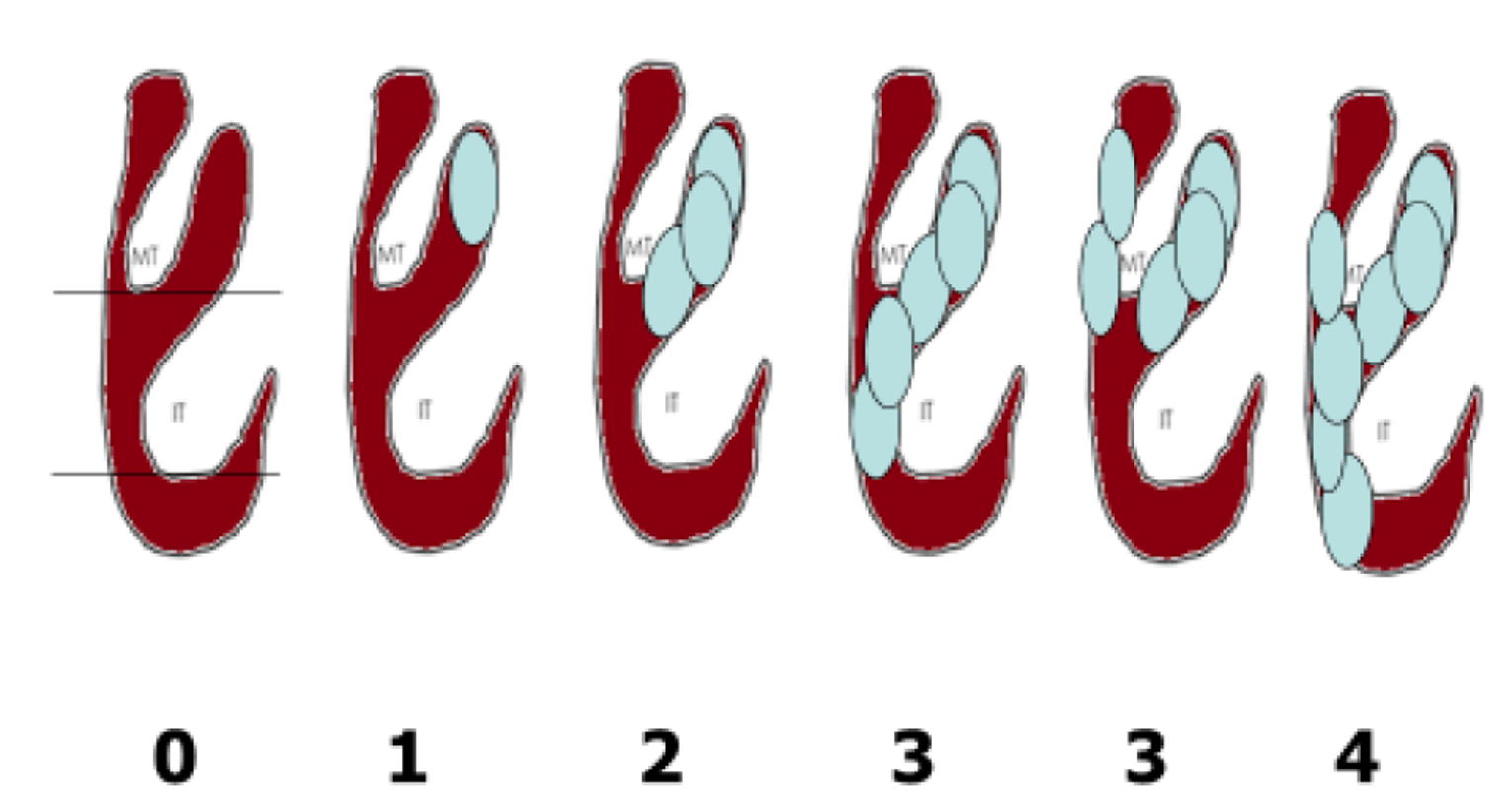The figure shows 6 illustrations of a nasal passage, each with a different number of polyps in different positions (the first has no polyps). Under each illustration is the nasal polyp score: 0, 1, 2, 3, 3, 4. These scores are defined as follows: 0 = no polyps; 1 = small polyps in the middle meatus not reaching below the inferior border of the middle concha; 2 = polyps reaching below the lower border of the middle turbinate; 3 = large polyps reaching the lower border of the inferior turbinate or polyps medial to the middle concha; 4 = large polyps causing complete congestion or obstruction of the inferior meatus.