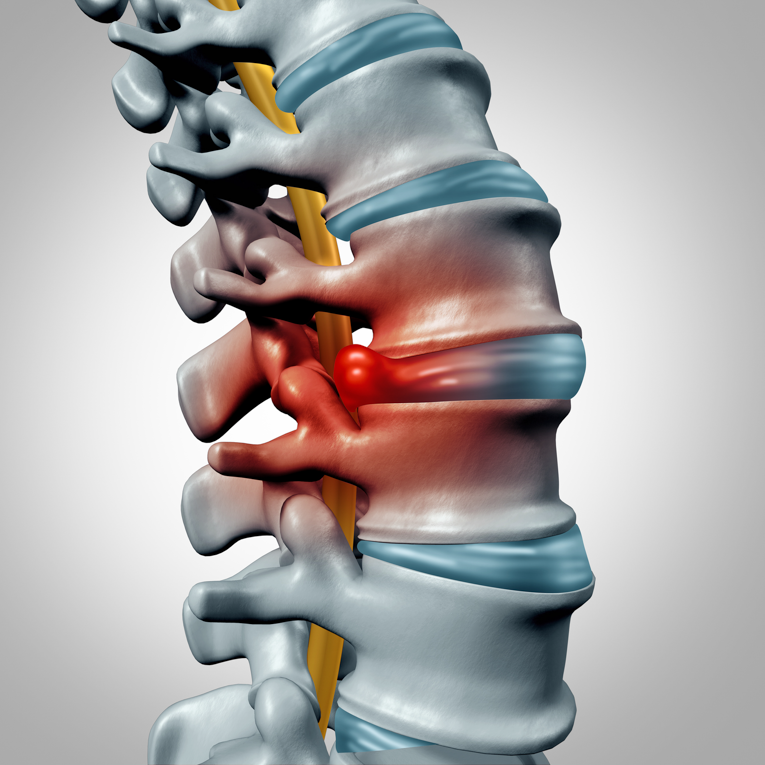 Three-Dimensional Anatomic Diagram of Spinal Column Segment With Herniated Disc