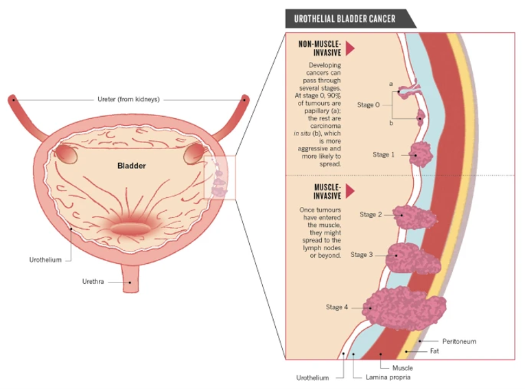 Diagram of UC stages highlighting the extent of tumour growth into the bladder wall in NMIBC, MIBC, and metastatic UC. Stage 0 and I are included as NMIBC, Stage II and III are included as MIBC, and stage IV represents metastatic UC.